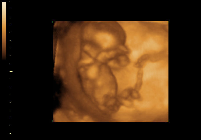 3D ultrasound image at 14 weeks